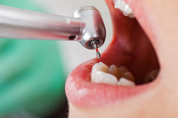Best Emergency Tooth Extraction in Ponca City, OK